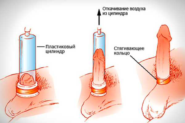 Вакуумное воздействие